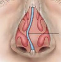 Qu'est-ce qu'une déviation du septum nasal ? Cloison, parois du ...